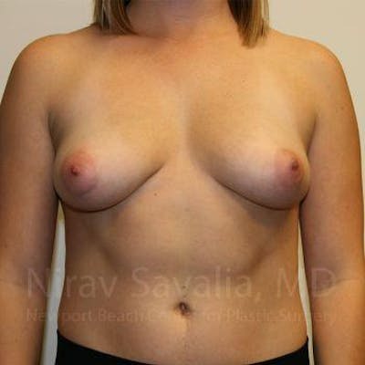 Breast Augmentation Before & After Gallery - Patient 1655593