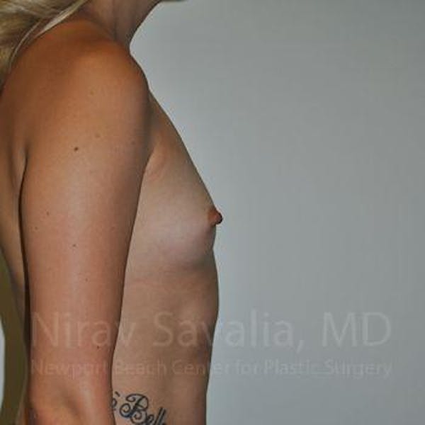 Breast Augmentation Before & After Gallery - Patient 1655595 - Before1