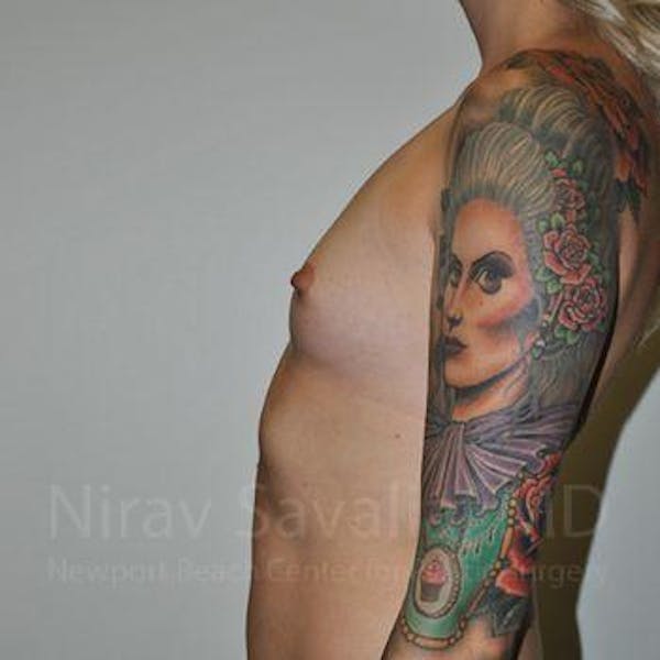 Breast Augmentation Before & After Gallery - Patient 1655595 - Before1