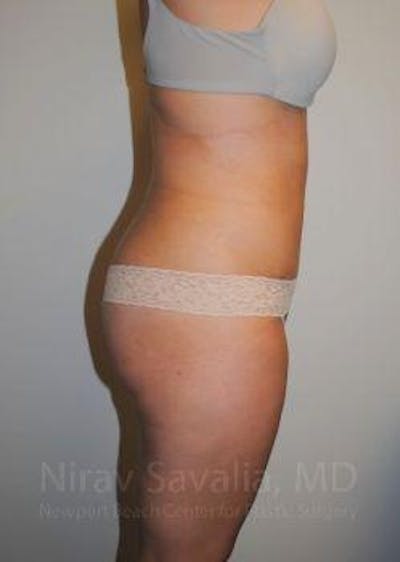 Abdominoplasty Tummy Tuck Before & After Gallery - Patient 1655598 - After1
