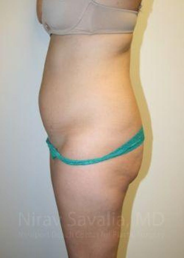Abdominoplasty Tummy Tuck Before & After Gallery - Patient 1655598 - Before1