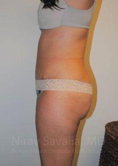 Abdominoplasty Tummy Tuck Before & After Gallery - Patient 1655598 - After1