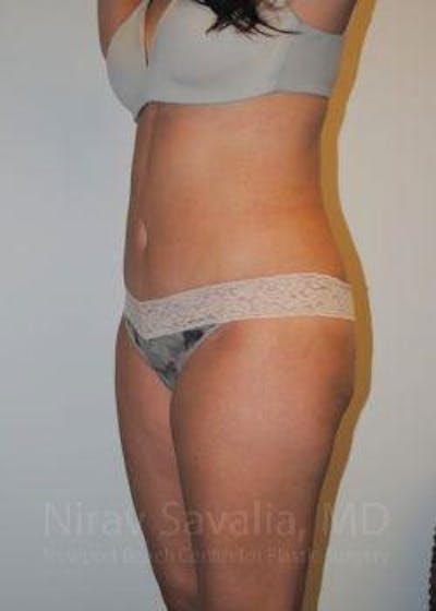 Abdominoplasty Tummy Tuck Before & After Gallery - Patient 1655598 - After1