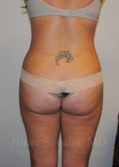 Abdominoplasty Tummy Tuck Before & After Gallery - Patient 1655598 - After1