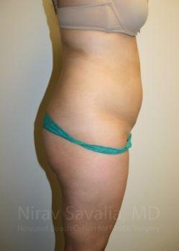 Liposuction Before & After Gallery - Patient 1655599 - Before1