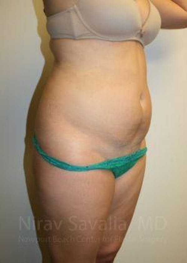 Liposuction Before & After Gallery - Patient 1655599 - Before1