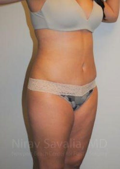 Liposuction Before & After Gallery - Patient 1655599 - After1