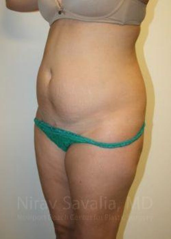 Liposuction Before & After Gallery - Patient 1655599 - Before1