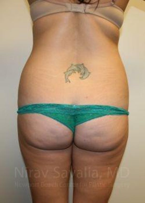 Liposuction Before & After Gallery - Patient 1655599 - Before1