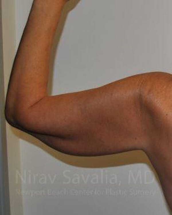 Arm Lift Before & After Gallery - Patient 1655600 - Before1