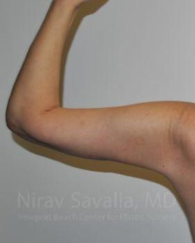 Arm Lift Before & After Gallery - Patient 1655600 - After1