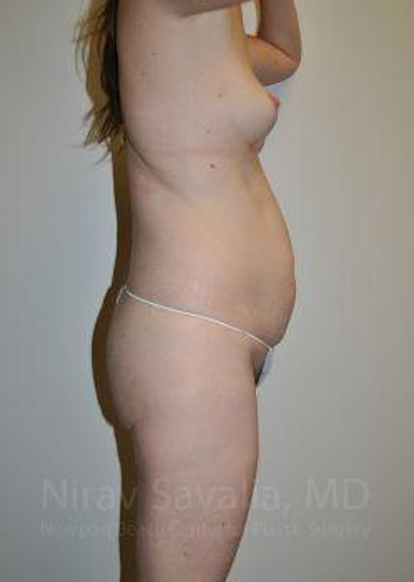 Liposuction Before & After Gallery - Patient 1655603 - Before1