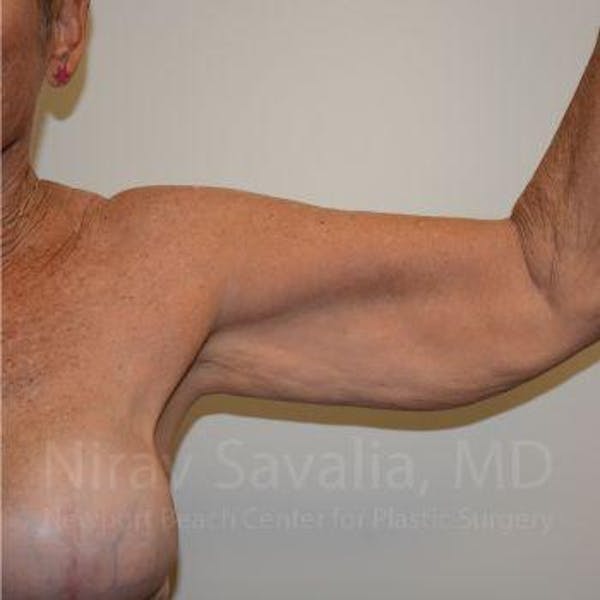 Arm Lift Before & After Gallery - Patient 1655602 - Before1