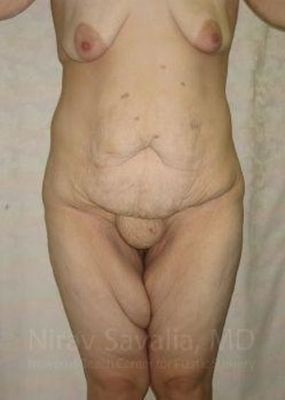 Thigh Lift Before & After Gallery - Patient 1655604 - Before1