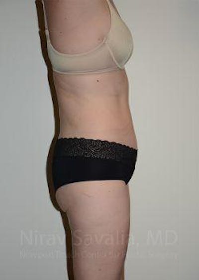 Liposuction Before & After Gallery - Patient 1655603 - After1