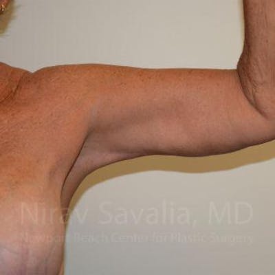 Arm Lift Before & After Gallery - Patient 1655602 - After1