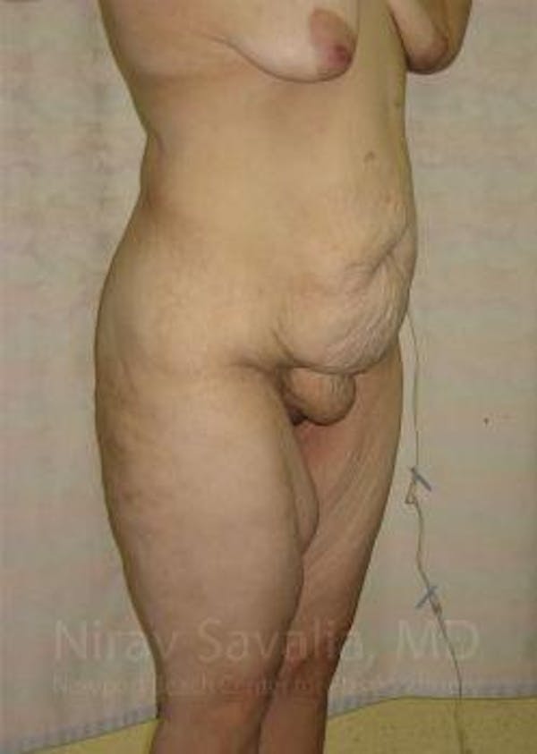 Thigh Lift Before & After Gallery - Patient 1655604 - Before1