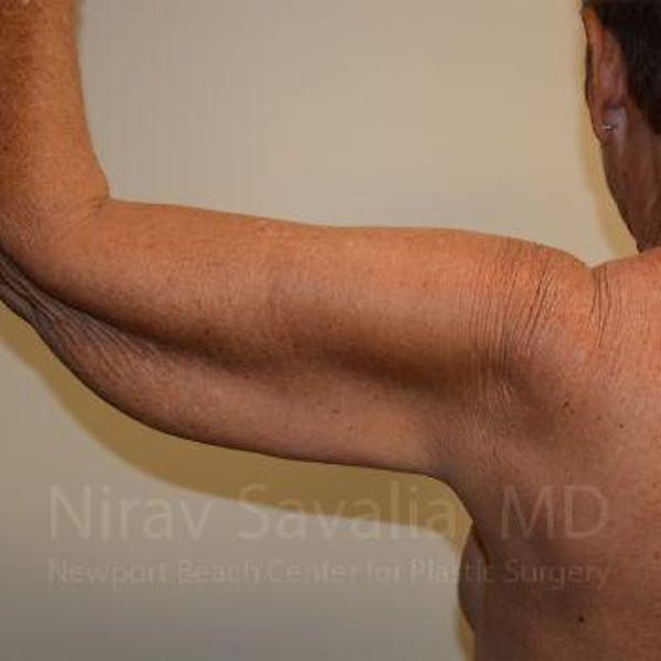 Arm Lift Before & After Gallery - Patient 1655602 - Before1