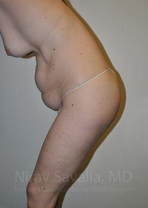 Liposuction Before & After Gallery - Patient 1655603 - Before1