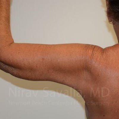 Arm Lift Before & After Gallery - Patient 1655602 - After1