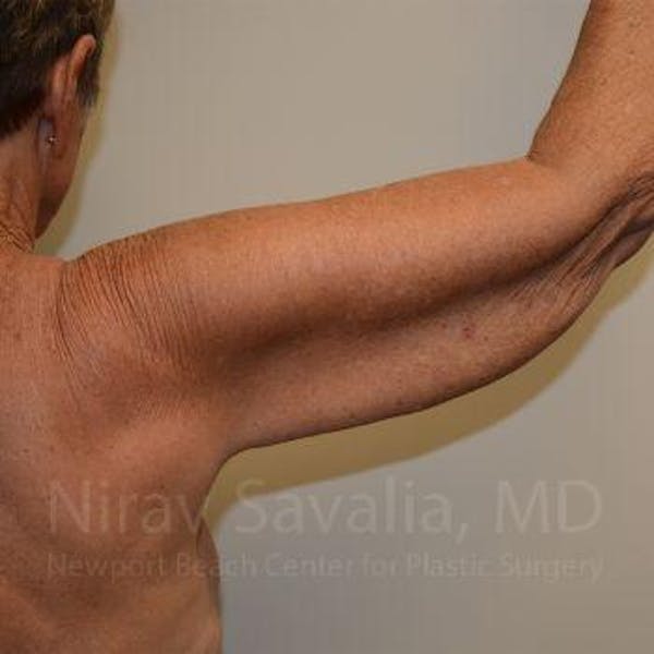 Arm Lift Before & After Gallery - Patient 1655602 - Before1