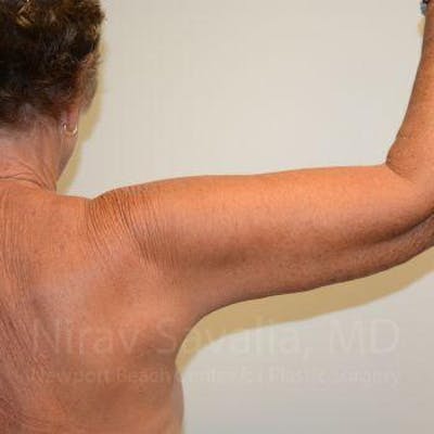 Arm Lift Before & After Gallery - Patient 1655602 - After1