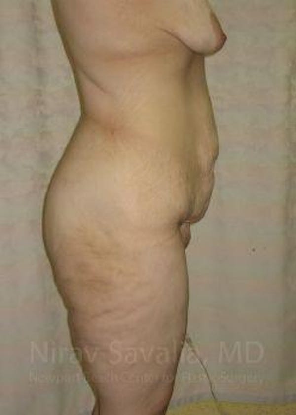 Thigh Lift Before & After Gallery - Patient 1655604 - Before1