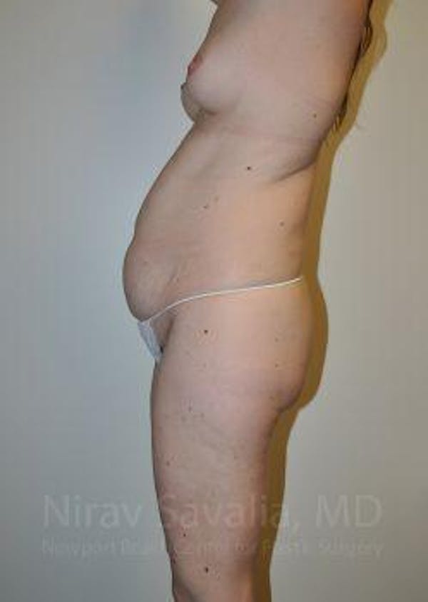 Abdominoplasty Tummy Tuck Before & After Gallery - Patient 1655605 - Before1