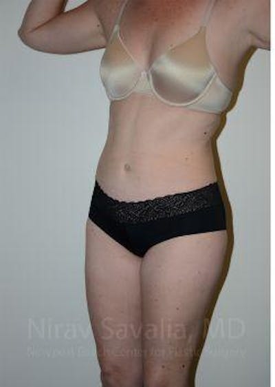 Liposuction Before & After Gallery - Patient 1655603 - After1