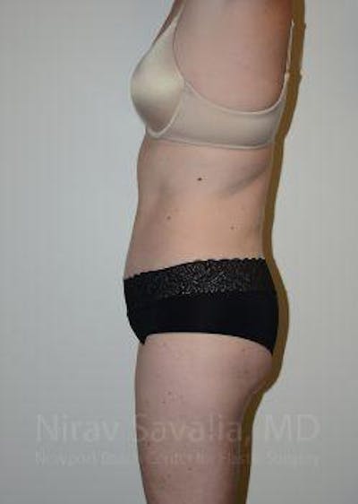 Abdominoplasty Tummy Tuck Before & After Gallery - Patient 1655605 - After1