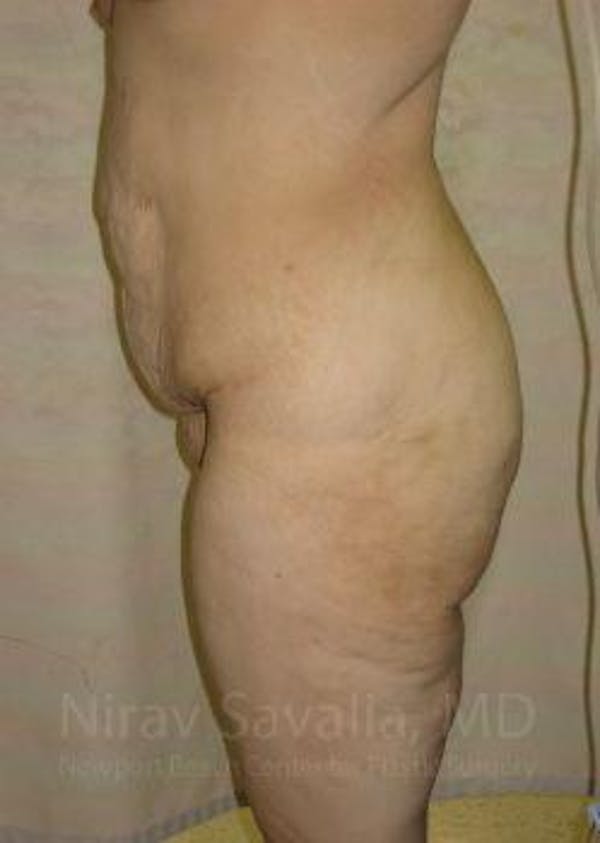 Thigh Lift Before & After Gallery - Patient 1655604 - Before1