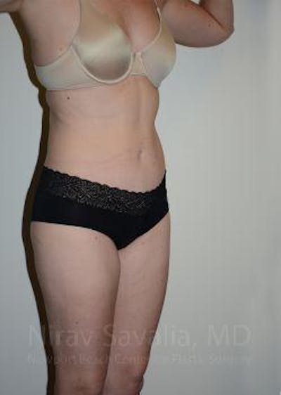 Abdominoplasty Tummy Tuck Before & After Gallery - Patient 1655605 - After1