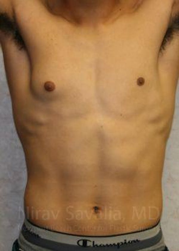 Male Breast Reduction Before & After Gallery - Patient 1655607 - Before1