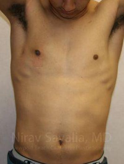 Male Breast Reduction Before & After Gallery - Patient 1655607 - After1