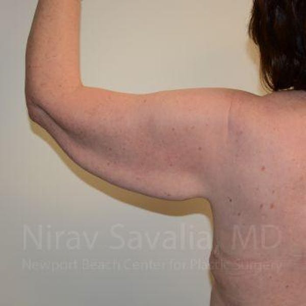 Arm Lift Before & After Gallery - Patient 1655606 - Before1