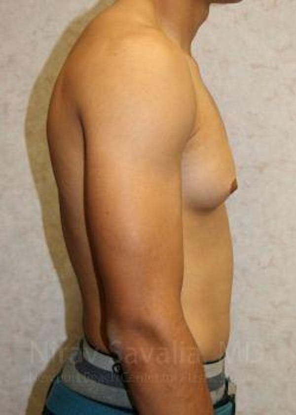 Male Breast Reduction Before & After Gallery - Patient 1655607 - Before1