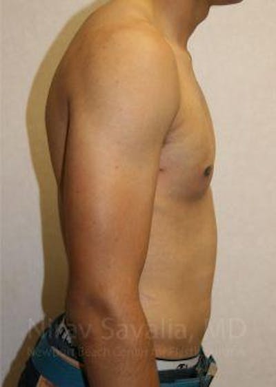 Male Breast Reduction Before & After Gallery - Patient 1655607 - After1