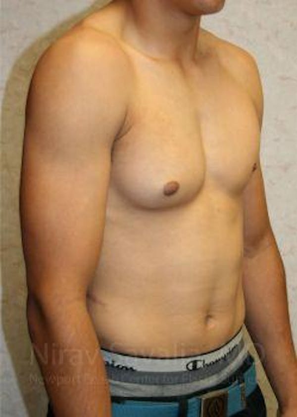 Male Breast Reduction Before & After Gallery - Patient 1655607 - Before1