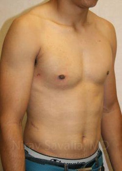 Male Breast Reduction Before & After Gallery - Patient 1655607 - After1