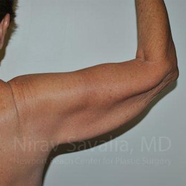 Arm Lift Before & After Gallery - Patient 1655610 - Before1