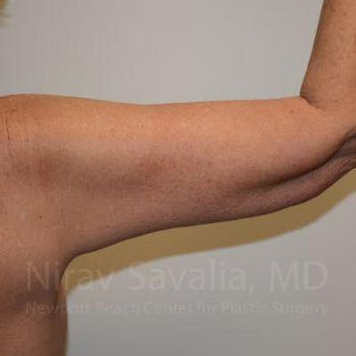 Arm Lift Before & After Gallery - Patient 1655610 - After1