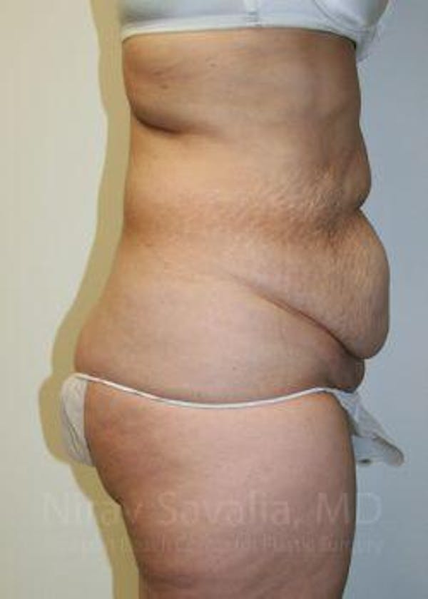 Body Contouring after Weight Loss Before & After Gallery - Patient 1655611 - Before1