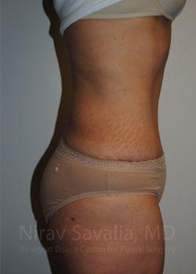 Body Contouring after Weight Loss Before & After Gallery - Patient 1655611 - After1