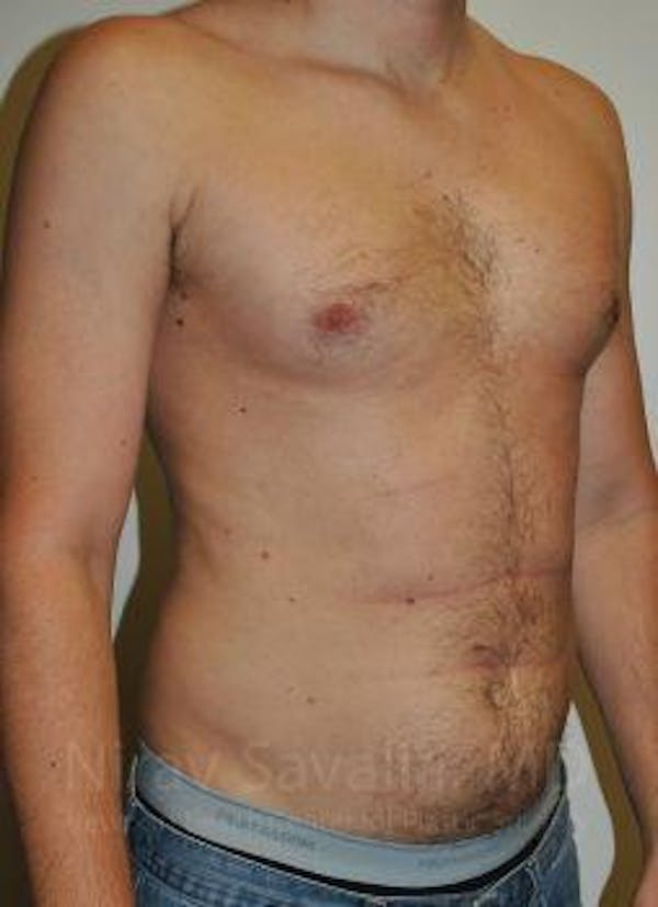 Male Breast Reduction Before & After Gallery - Patient 1655612 - Before1