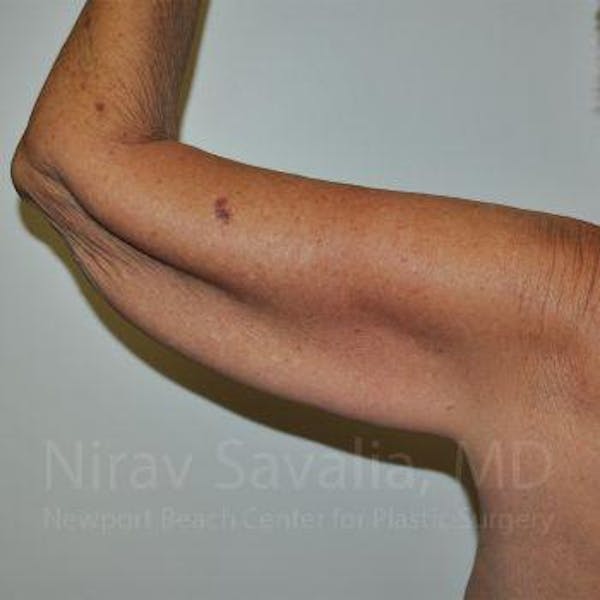 Arm Lift Before & After Gallery - Patient 1655610 - Before1