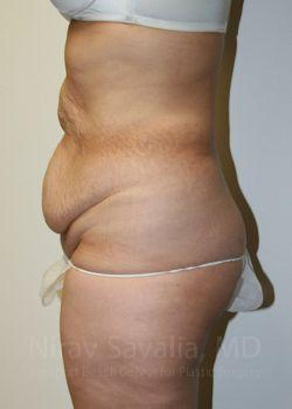 Body Contouring after Weight Loss Before & After Gallery - Patient 1655611 - Before1