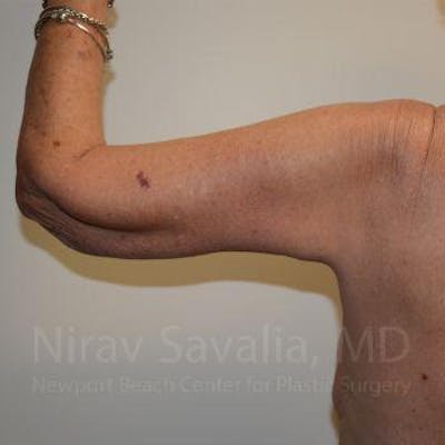 Arm Lift Before & After Gallery - Patient 1655610 - After1