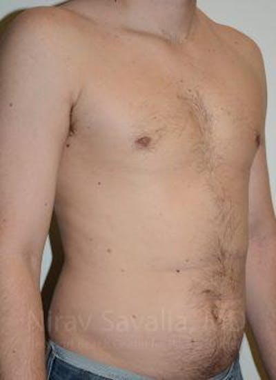 Male Breast Reduction Before & After Gallery - Patient 1655612 - After1
