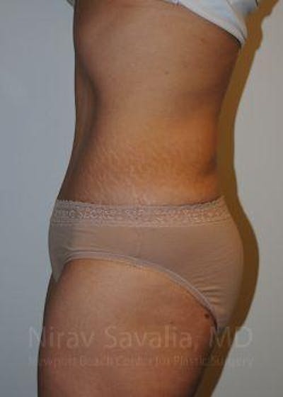 Body Contouring after Weight Loss Before & After Gallery - Patient 1655611 - After1