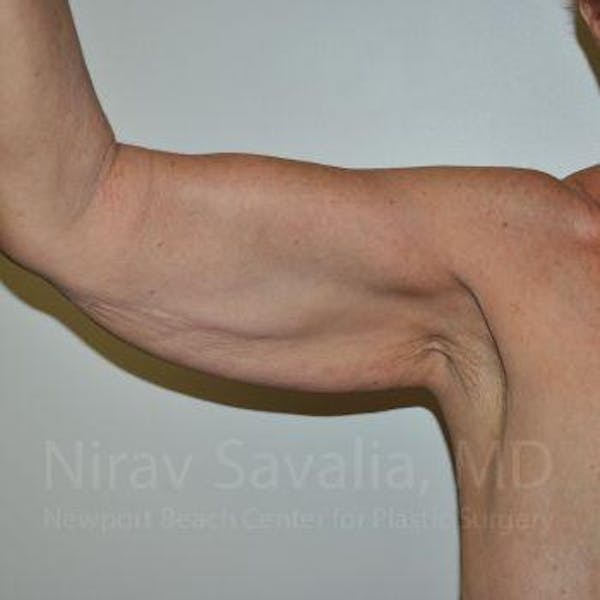 Arm Lift Before & After Gallery - Patient 1655610 - Before1